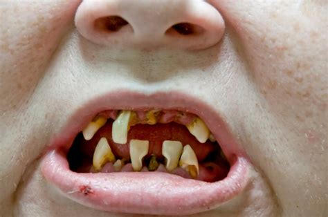 horrible teeth pics